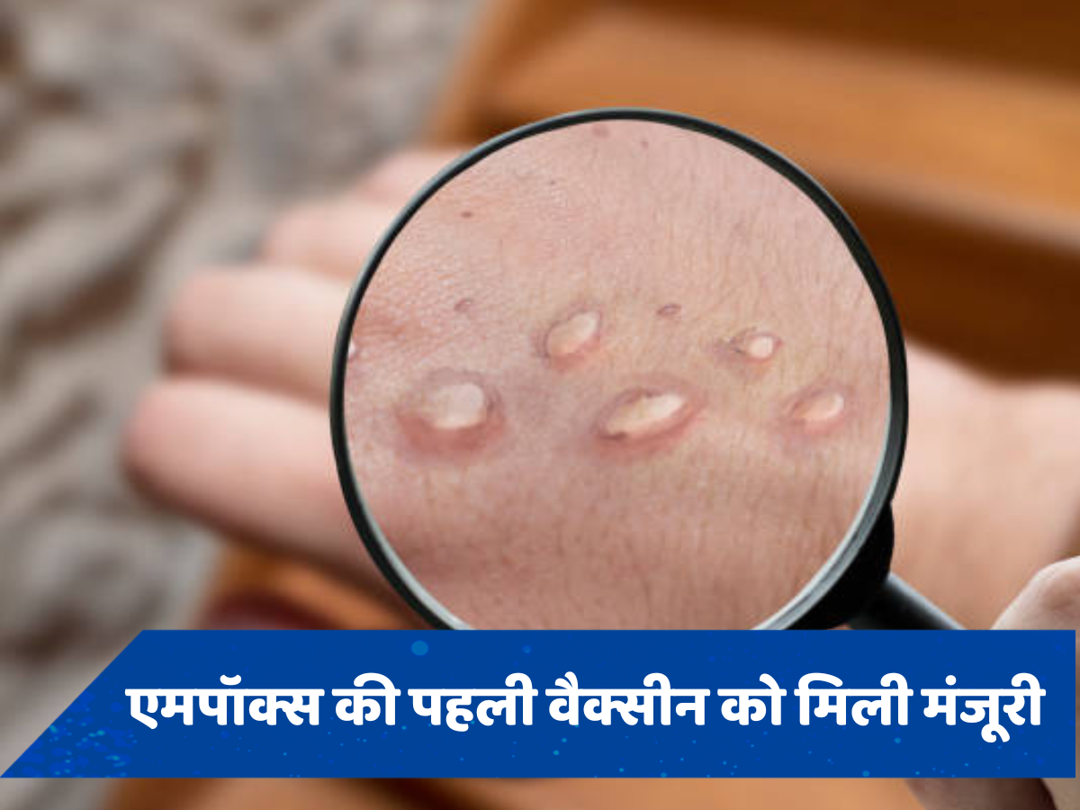मंकीपॉक्स की जल्द हो सकती है छुट्टी? WHO ने पहली वैक्सीन को दी मंजूरी, इस देश में शुरु होगा वैक्सीनेशन