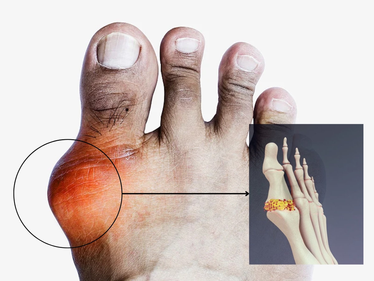 Uric Acid: इन 5 संकेतों से समझें ज्वाइंट्स में भर रहा यूरिक एसिड, कंट्रोल करने के लिए तुरंत से खाना शुरू कर दें ये दाल