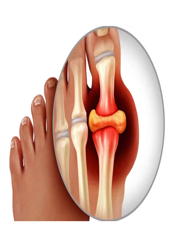 Uric Acid Treatment: इन 7 चीजों से करें तौबा, कोसों दूर भागेगा यूरिक एसिड