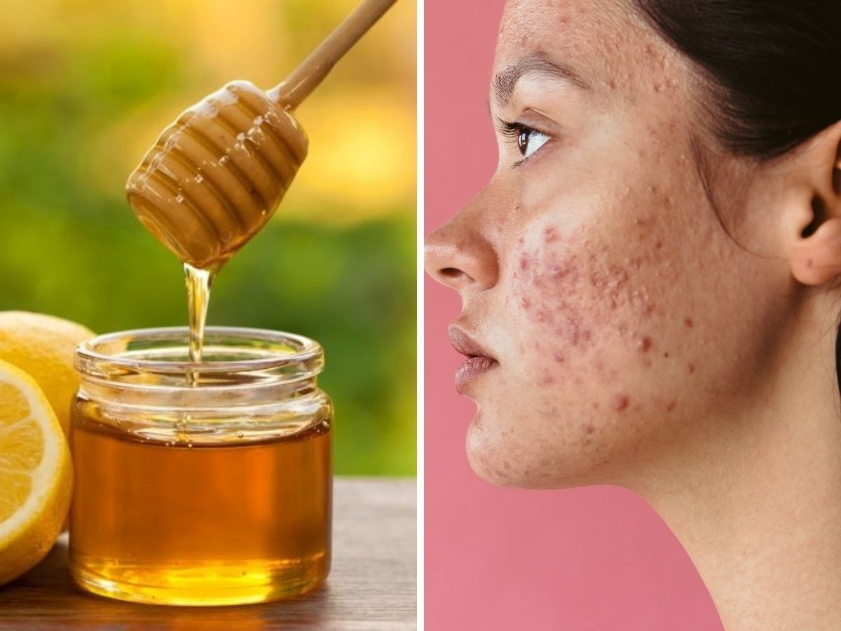 Acne Home Remedies: शहद के साथ इस पीले फल को मिलाकर चेहरे पर लगाएं, हमेशा के लिए मुंहासों से मिल जाएगा छुटकारा!