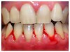 आपके मसूड़ों से खून न‍िकलना 