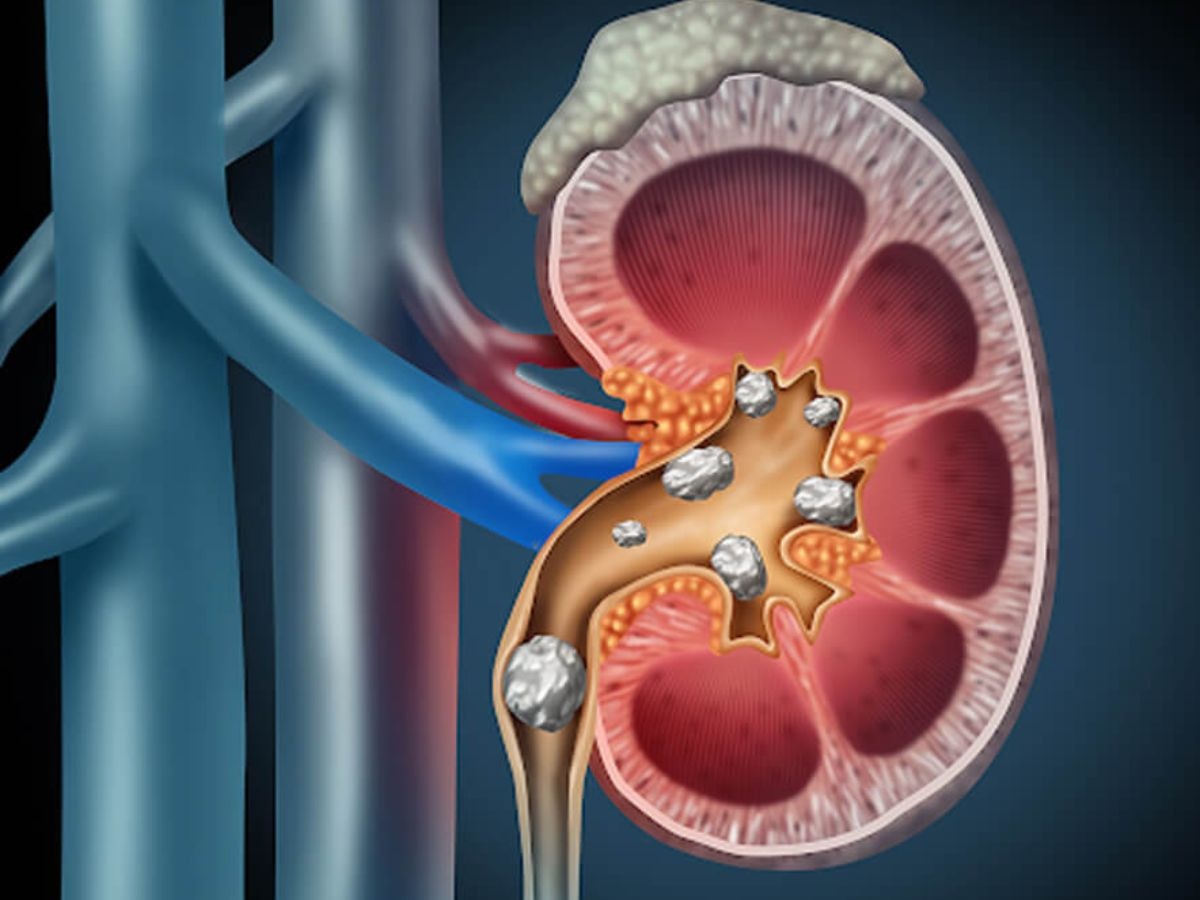 Kidney Stone: क्या कम पानी पीने की वजह से किडनी में पथरी हो जाती है? एक्सपर्ट से जानें सही जवाब और बीमारी से बचने के उपाय