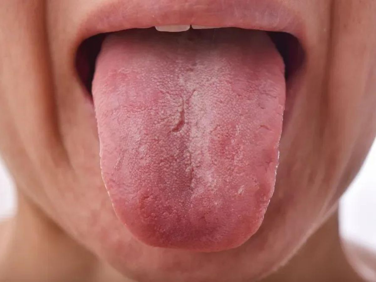 जीभ पर सूजन और मुंह के छाले