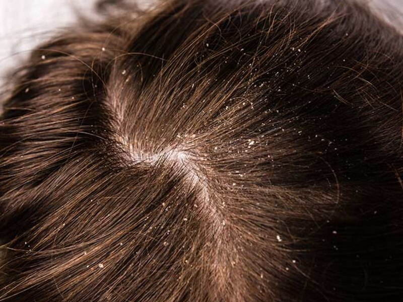 डैंड्रफ से कैसे पाएं राहत