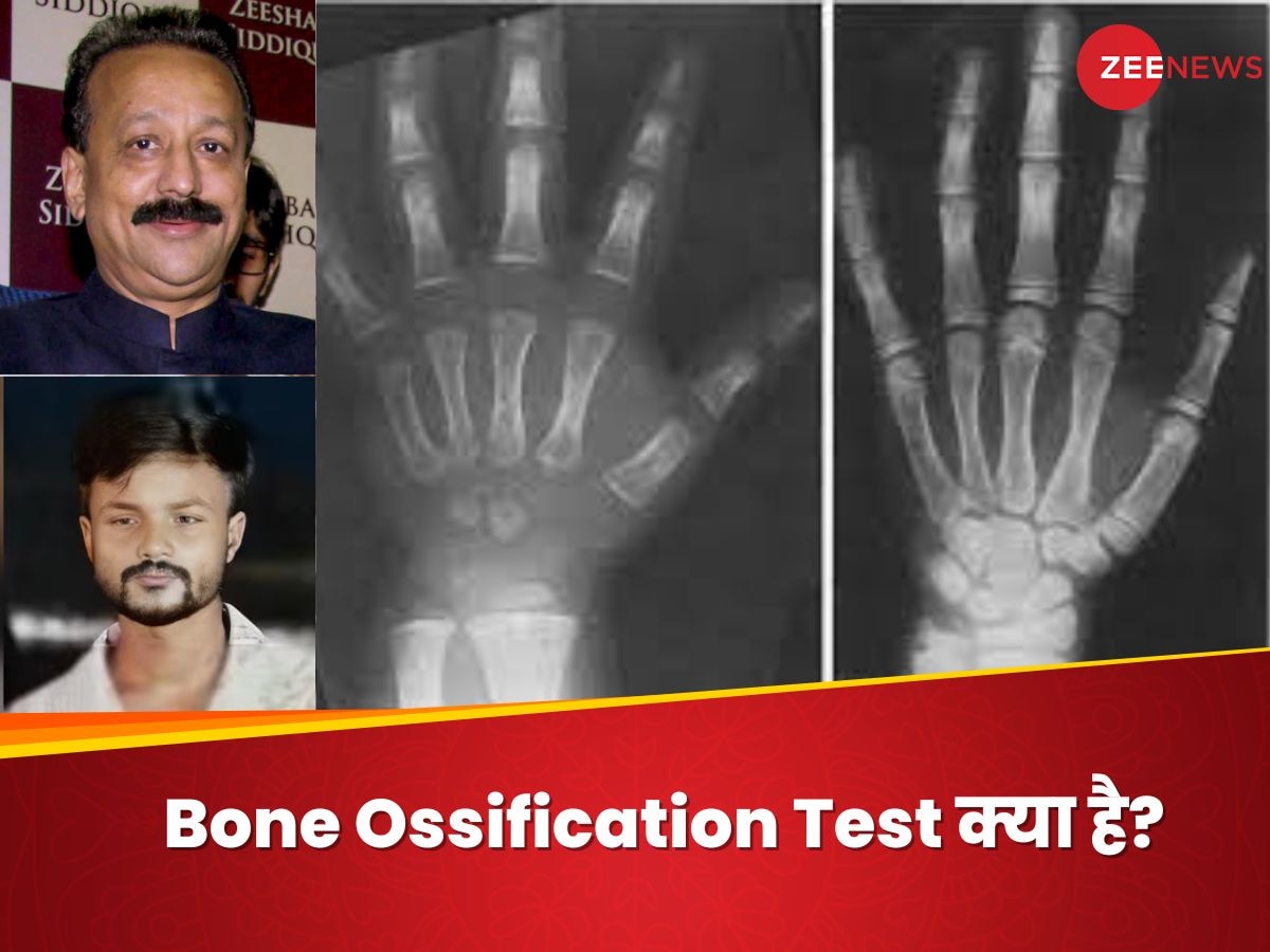 Bone Ossification Test: हड्डियों के टेस्ट से उम्र का पता कैसे लगता है? बाबा सिद्दीकी मर्डर केस में यूज हुआ ये तरीका