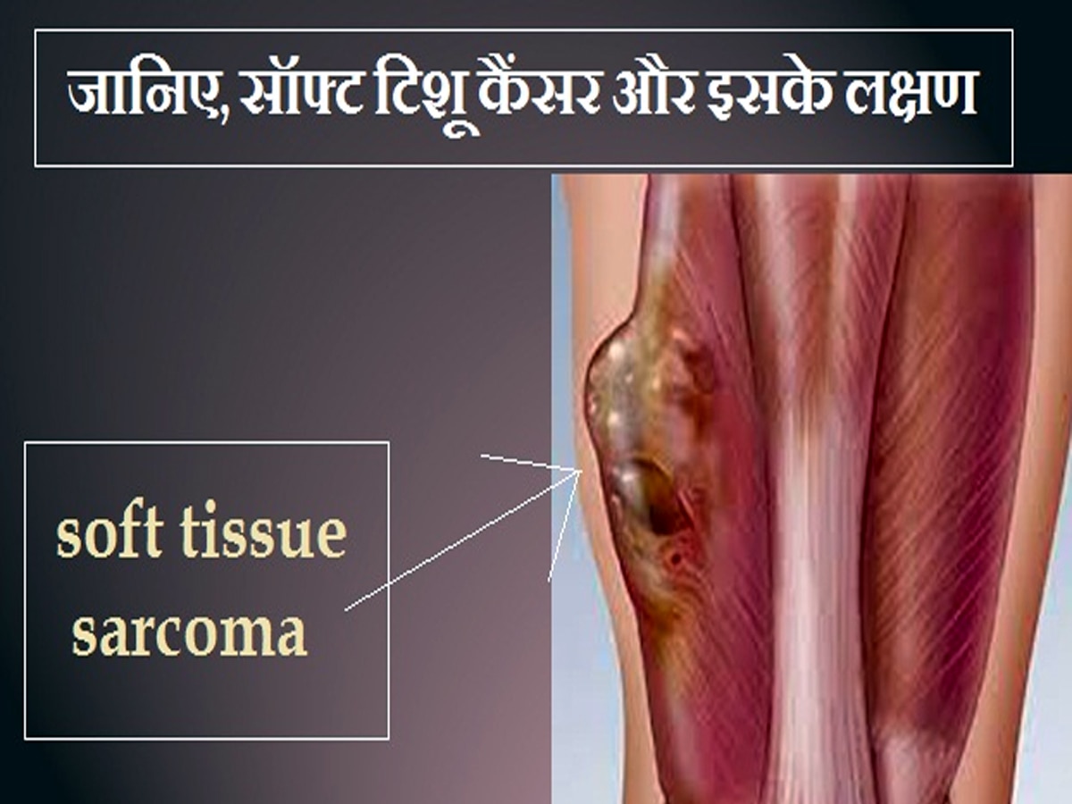 Liposarcoma: मरीज के लिए डॉक्टर बने भगवान.. मिली असहनीय दर्द से निजात, पैर से निकला 3 किलो का ट्यूमर