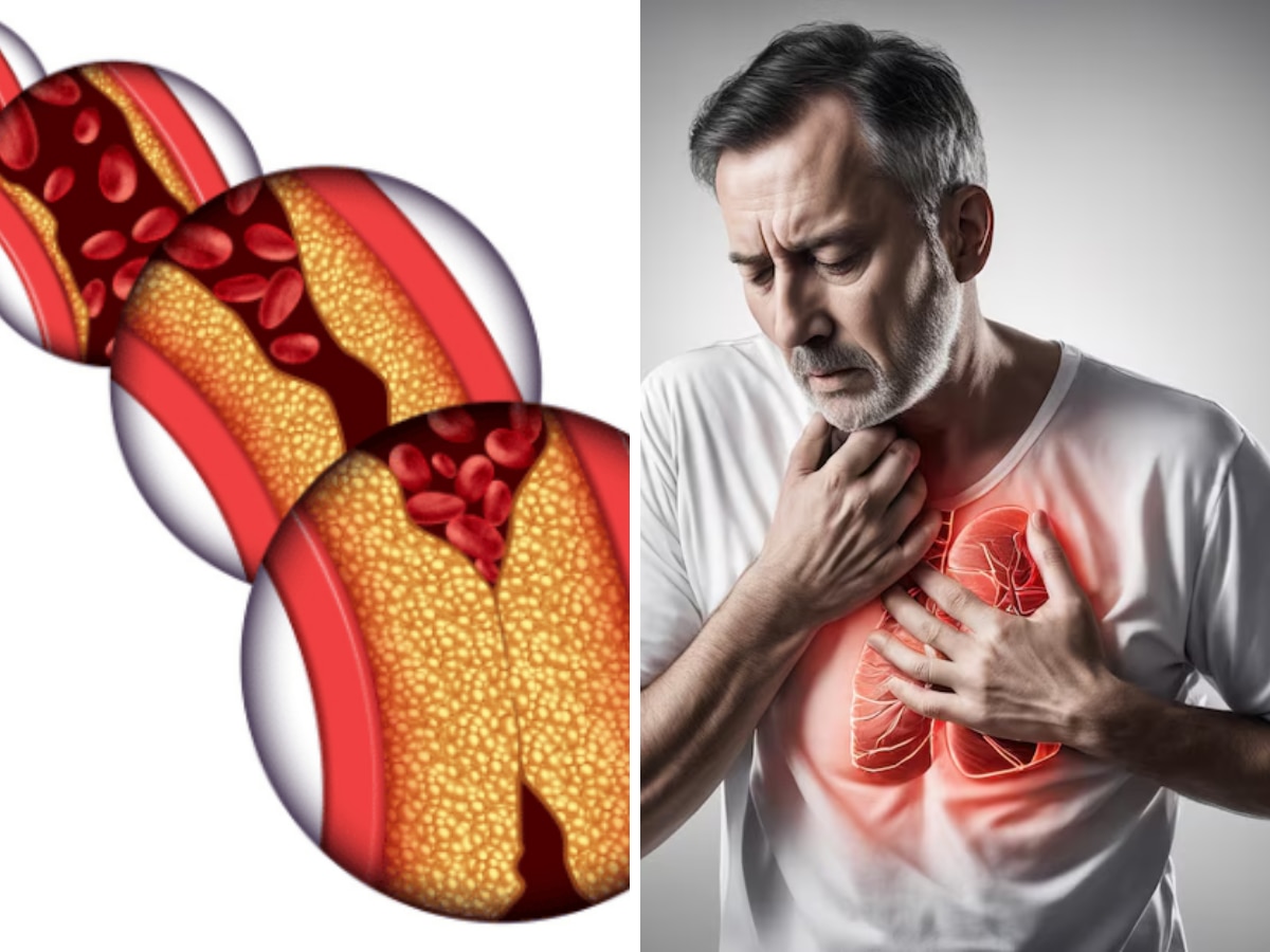 कोलेस्ट्रॉल बढ़ने पर कितने दिनों में होता है Heart Attack? हार्ट स्पेशलिस्ट ने बताया सटीक समय