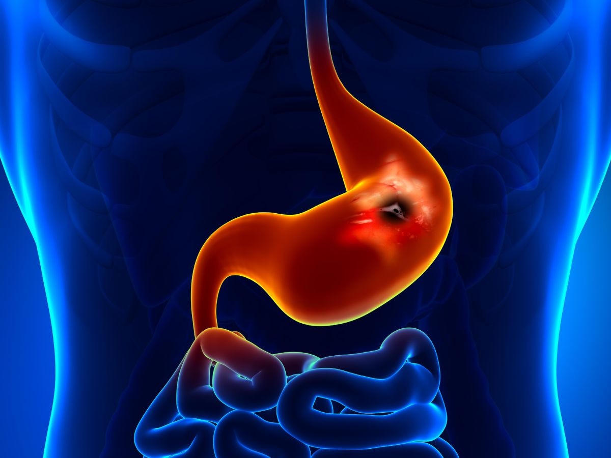 Stomach Ulcer: पेट में अल्सर का खतरा बढ़ाती हैं ये 5 गलतियां, आपकी सेहत हो सकती है को तबाह, तुरंत करें सुधार