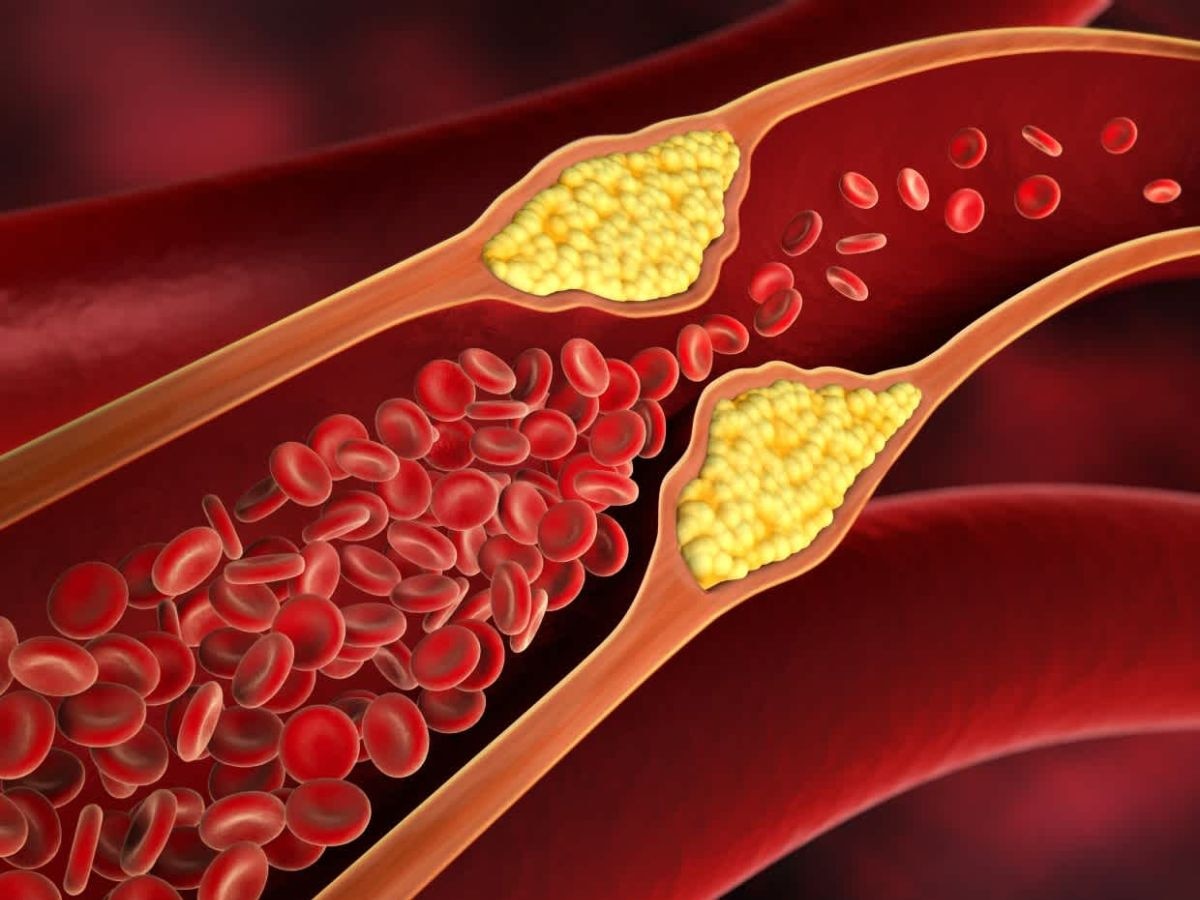 LDL Cholesterol: बैड कोलेस्ट्रॉल घटाने का रामबाण इलाज, घर पर करें ये 5 चीजें और देखें कमाल!