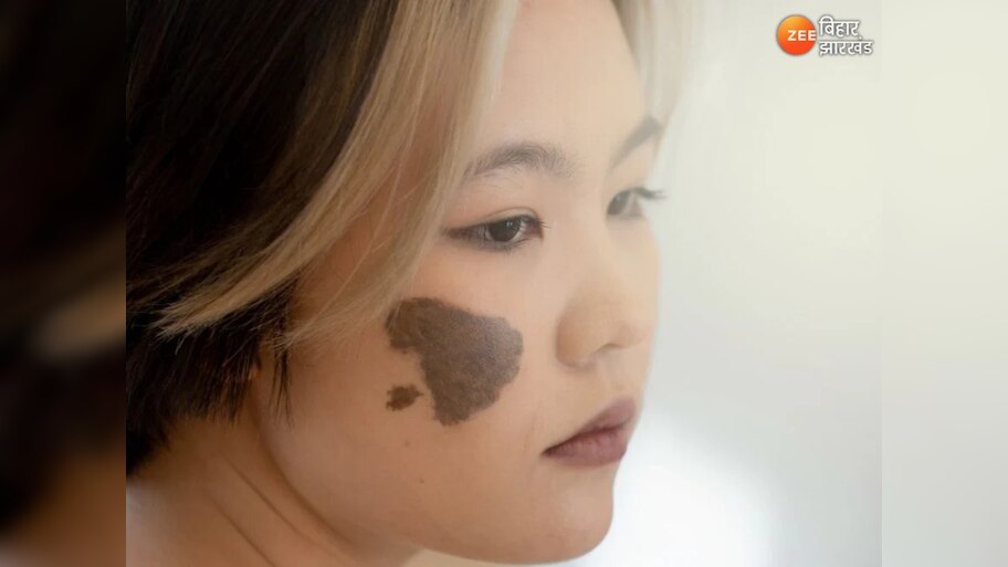 Birthmark Astrology: शरीर के बर्थमार्क का ज्योतिषीय महत्व, जानें आपकी किस्मत के संकेत