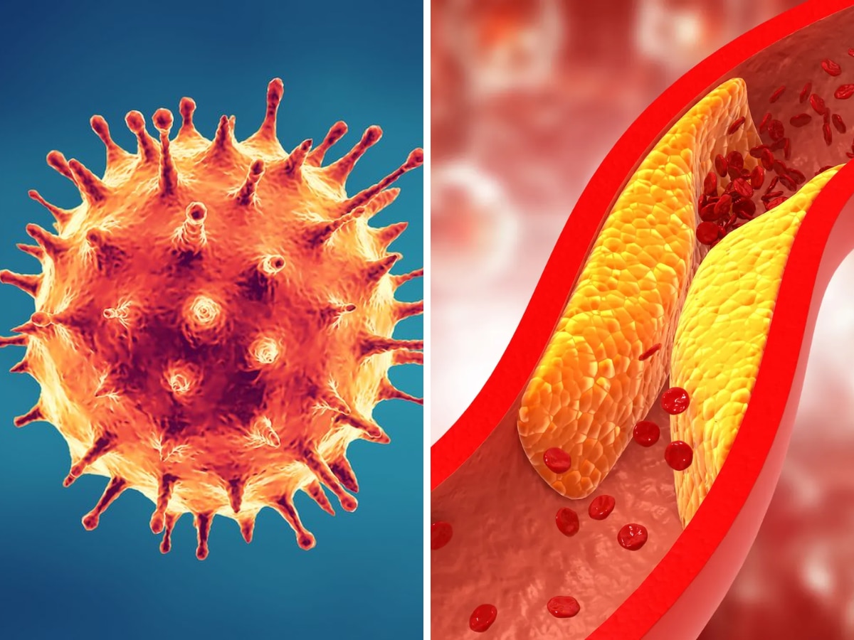 कोविड-19 से 30 प्रतिशत तक बढ़ गया हाई कोलेस्ट्रॉल का खतरा; शोध में हुआ खुलासा