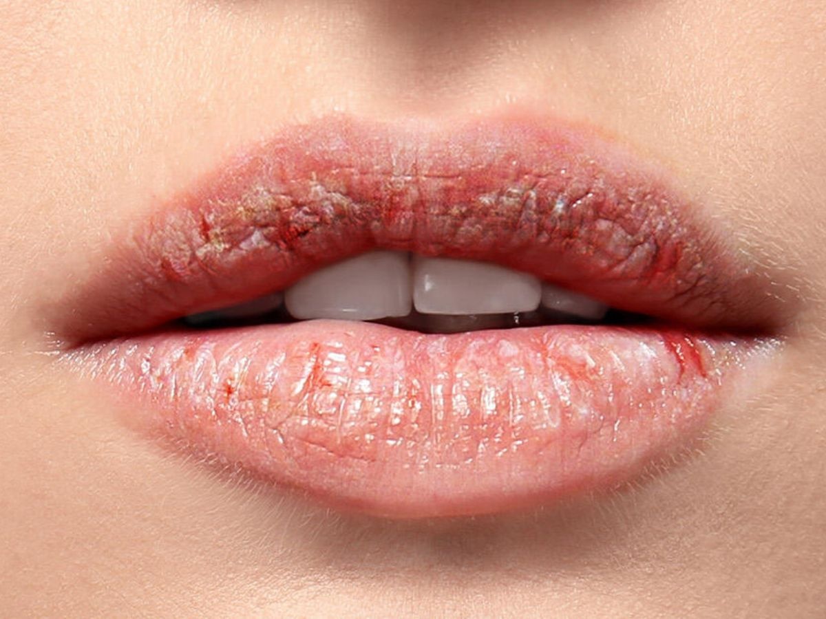 Dry Lips: इस ठंड के मौसम में ड्राई लिप्स से पाएं छुटकारा, इन पांच स्क्रब को करें ट्राई 