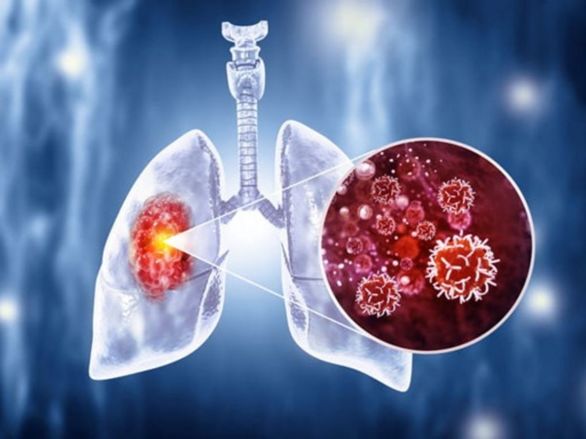 Lung Cancer: बिना धूम्रपान के भी फेफड़ों का कैंसर, भारत में वायु प्रदूषण बन रहा नया विलेन