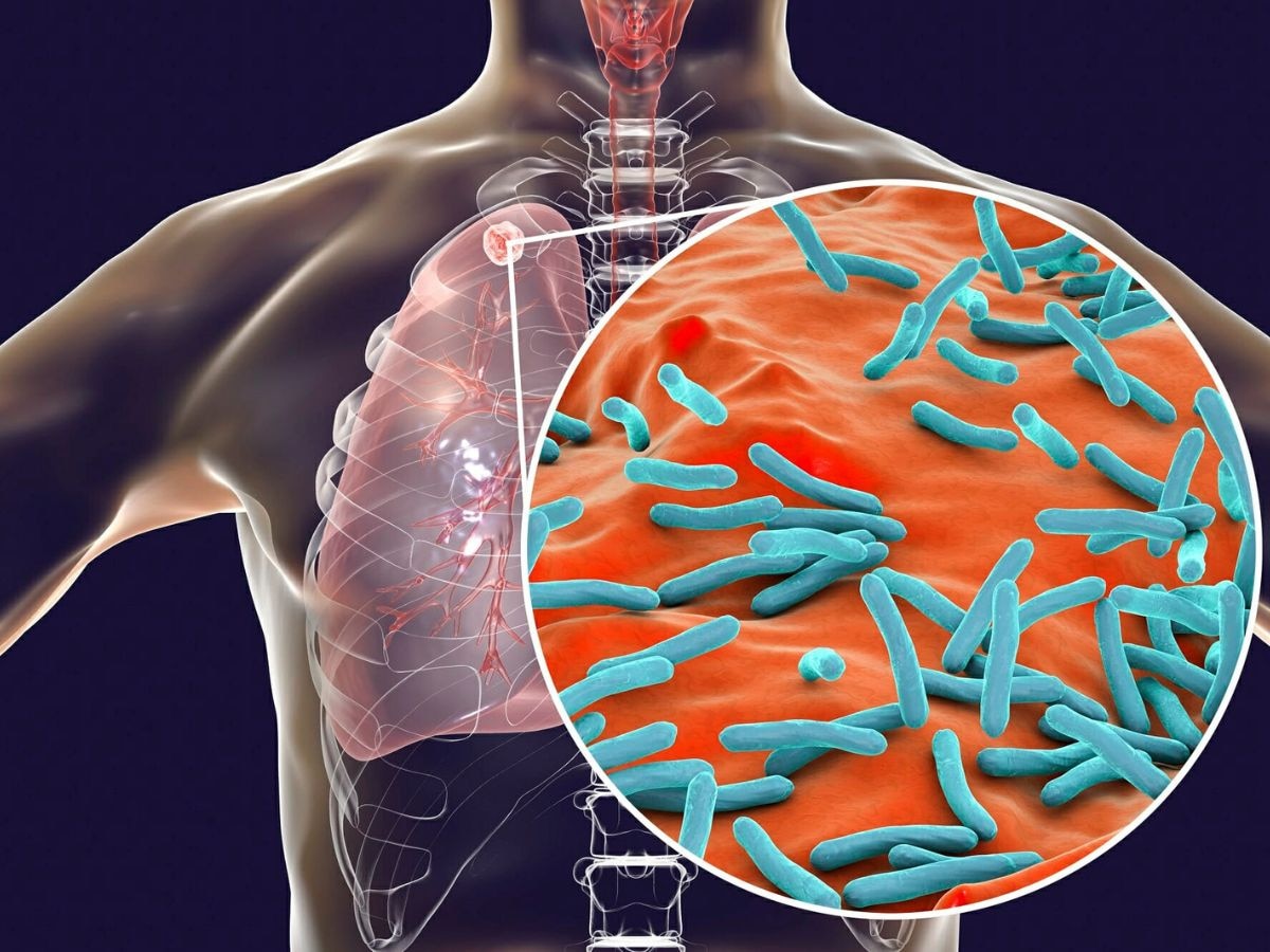 Tuberculosis: टीबी मरीजों के परिवार वालों पर योगी सरकार की नजर, हर तीन महीने में होगी जांच