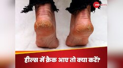 फटी एड़ियां चीख-चीखकर कह रही हैं, 'कुछ तो उपाय करो मालिक', हील्स को ऐसे बनाएं सॉफ्ट