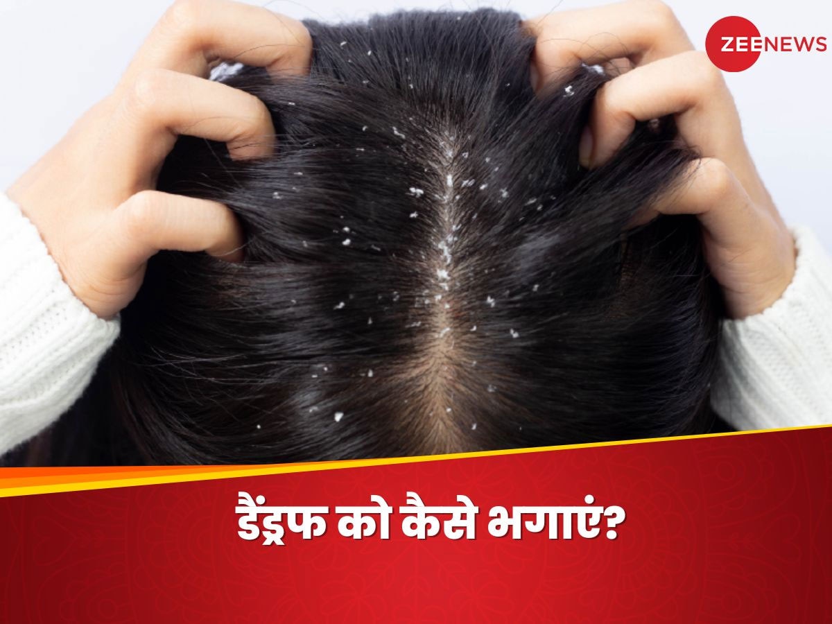 डैंड्रफ की वजह से होने लगी शर्मिंदगी? बालों के दुश्मन को इस तरह करें 'टाटा, बाय-बाय'