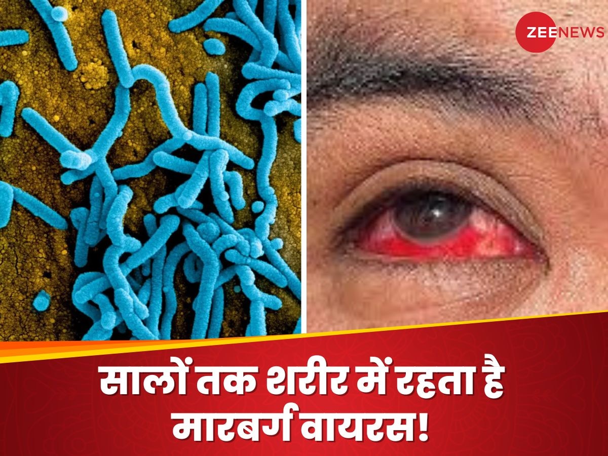 Bleeding Eye Virus: रिकवर के बाद बिल्कुल भी न बरतें लापरवाही, सालों तक अंगों में छुपा रहता है मारबर्ग वायरस