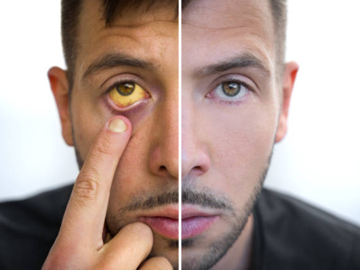 लिवर को सड़ा देती है ये बीमारी, आंखों में पीलापन समेत दिखते हैं ये लक्षण, न करें इग्नोर... 13 लिवर सिरोसिस के आम लक्षण