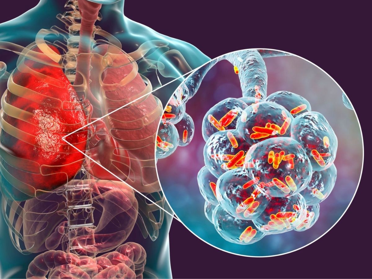 टीबी का साइलेंट अटैक! 2040 तक 6.2 करोड़ केस और 80 लाख मौतों का अनुमान, भारत में कैसे रुकेगी यह महामारी?