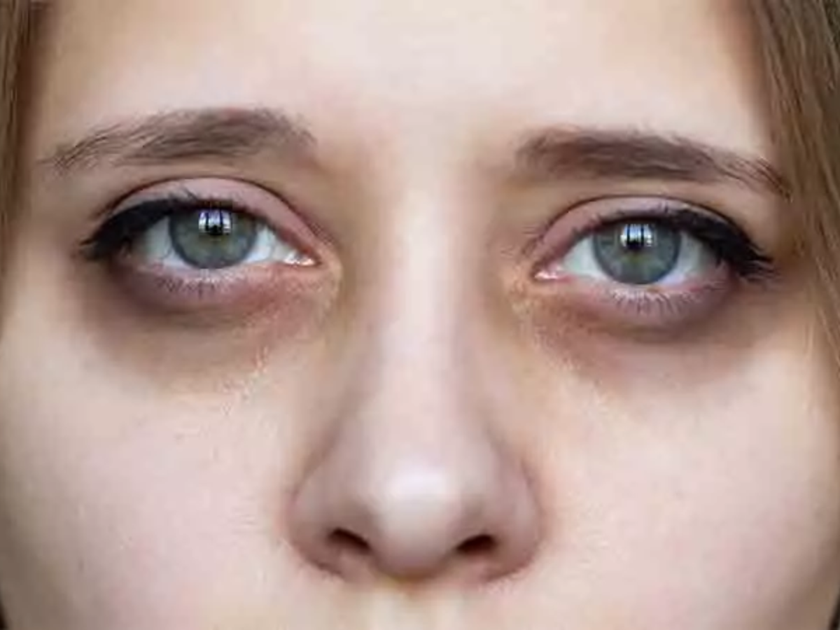 How Can I Remove Dark Circles Permanently Can Dark Circles Go Away how-can-i-remove-dark-circles-permanently-can-dark-circles-go-away