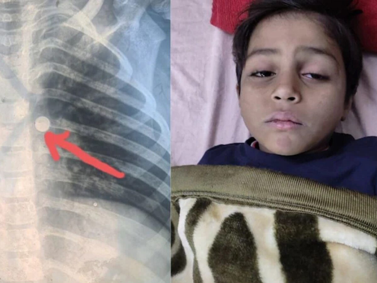 Rajasthan: 6 साल के बच्चे के फेफड़ें में फंस गया था घड़ी का सेल, कोटा के डॉक्टर्स ने ऑपरेशन कर निकाला बाहर Rajasthan: 6 साल के बच्चे के फेफड़ें में फंस गया था घड़ी का सेल, कोटा के डॉक्टर्स ने ऑपरेशन कर निकाला बाहर