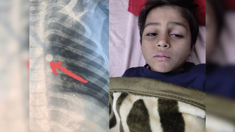 Rajasthan: 6 साल के बच्चे के फेफड़ें में फंस गया था घड़ी का सेल, कोटा के डॉक्टर्स ने ऑपरेशन कर निकाला बाहर