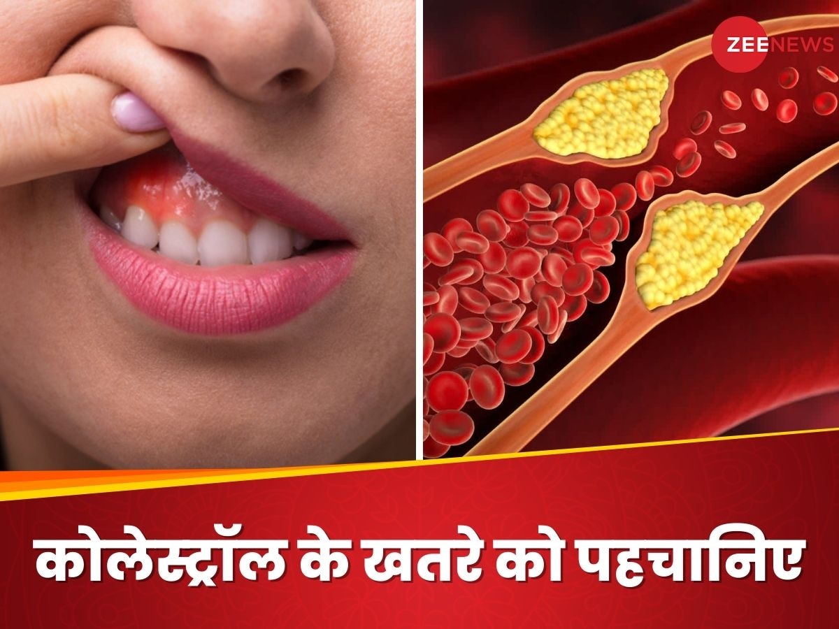 LDL Cholesterol: 'साइलेंट किलर' का राज खोल सकता है आपका मुंह, इन लक्षणों को पहचानें और बचाएं अपनी जान!