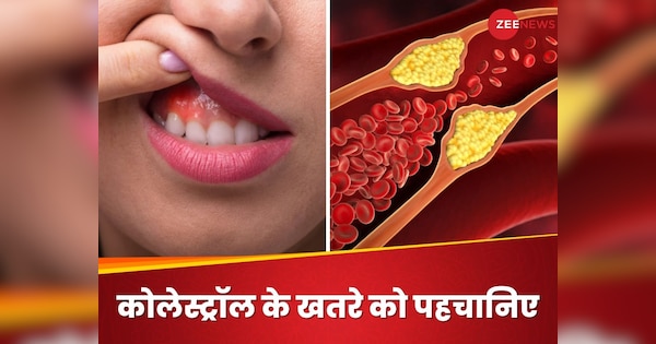 LDL Cholesterol: 'साइलेंट किलर' का राज खोल सकता है आपका मुंह, इन लक्षणों को पहचानें और बचाएं अपनी जान!