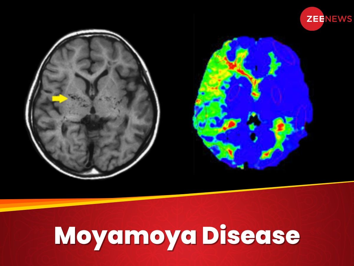 24 साल के शख्स के ब्रेन में भर गया था धुएं का गुबार, जानिए उसने मायामोया डिजीज को कैसे हराया