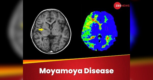 Moyamoya Disease Survivor Chee Ming Heng Who developed puff of smoke in ...