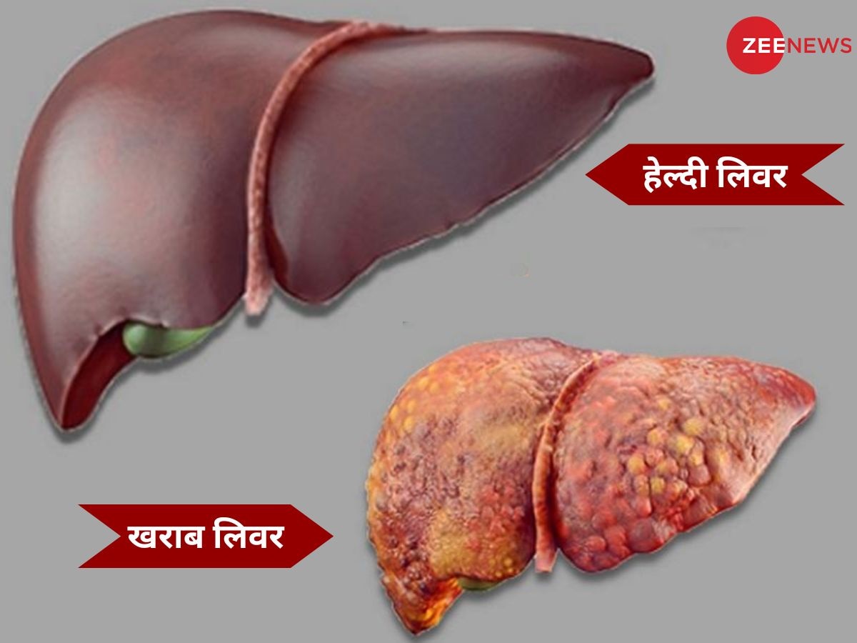 शराब ने लिवर को कर दिया बर्बाद? आयुर्वेद से होगा चमत्कार, ऑपरेशन की नहीं पड़ेगी जरूरत!