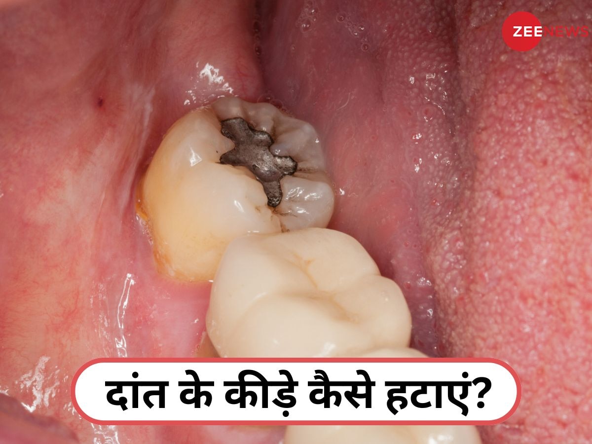 Cavity Remedies: दांतों को कीड़ों से छुटकारा दिलाएंगे ये घरेलू उपाय, मोतियों की तरह चमकेंगे दांत!