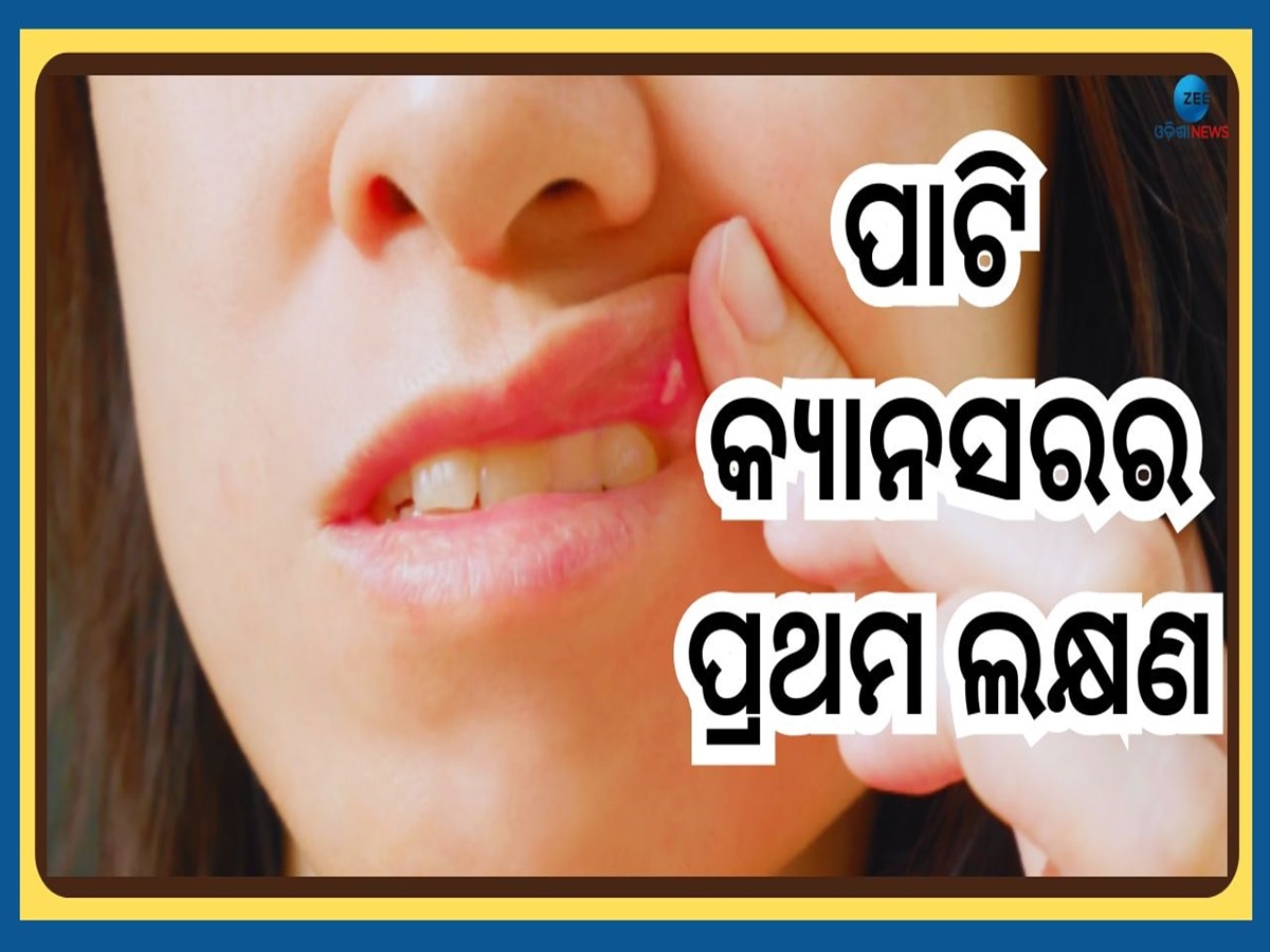 Oral Cancer Symptoms: ପାଟିରେ ଦେଖାଦେଉଥିବା ଏହି ସାମାନ୍ୟ ଲକ୍ଷଣ ହୋଇପାରେ କ୍ୟାନସରର କାରଣ