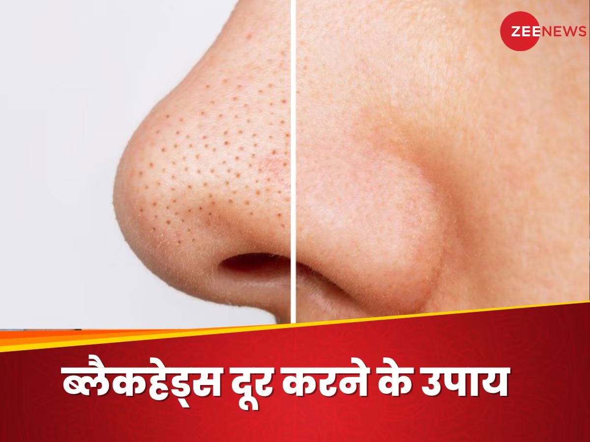 Blackheads ने बिगाड़ दी है शक्ल? घर पर बने इस स्क्रब से इनका काम होगा तमाम