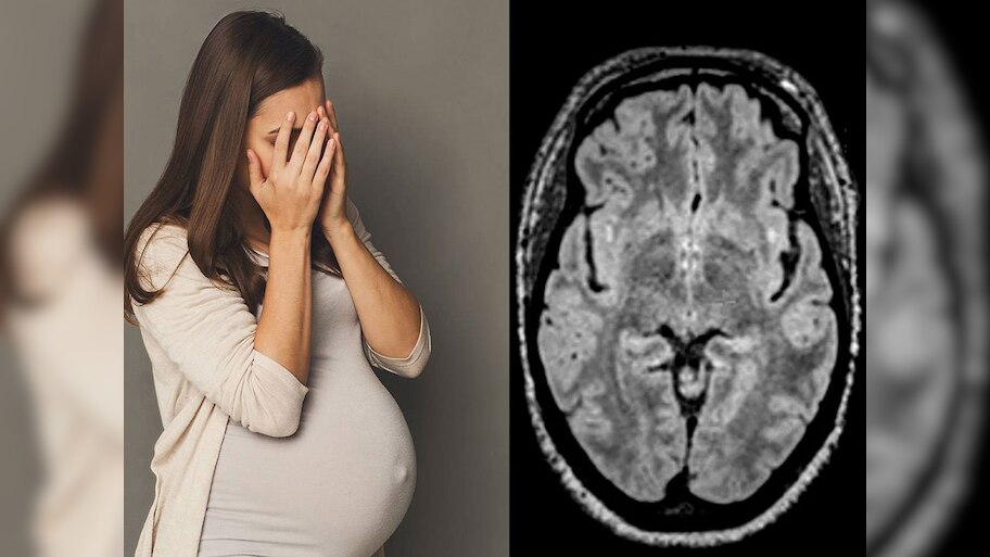 During Pregnancy 94 Percent grey matter in the brains of mother ...