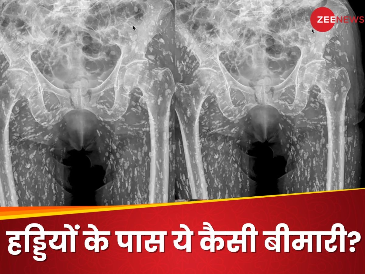 किचन में खाई ऐसी चीज, शुरू हो गया कमरदर्द, X-Ray करवाया तो देखते ही कांप उठे डॉक्टर्स