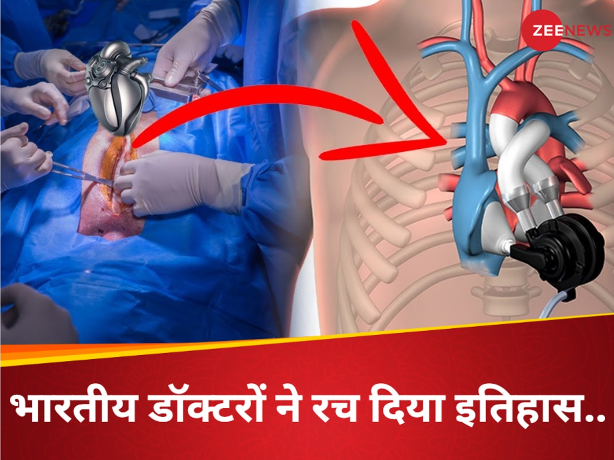 Heart Implant: भारत में पहली बार 'मेकैनिकल हार्ट' इम्प्लांट, मरीज को मिली नई जिंदगी, इस अस्पताल ने रच दिया इतिहास