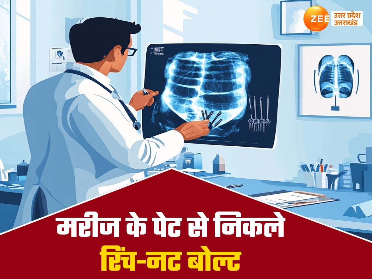 मरीज के पेट से निकले रिंच-नट बोल्ट, कोलकाता से यूपी लौटा बेटा तो मां-बाप रह गए हैरान