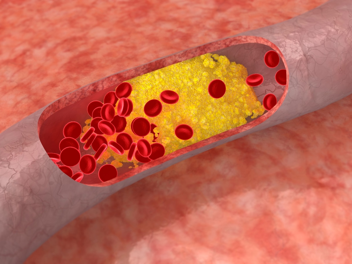 साइलेंट किलर है बैड कोलेस्ट्रॉल, आपको महसूस भी नहीं होगा और पड़ जाएगा दिल का दौरा! जान लीजिए ये जरूरी बातें