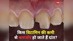 किस विटामिन की कमी से कमजोर होने लगते हैं दांत? बत्तीसी गायब होने से पहले जान लें