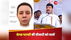 NCP नेता धनंजय मुंडे को हुआ Bell's Palsy, क्या है ये बीमारी, कैसे पहचानें लक्षण?
