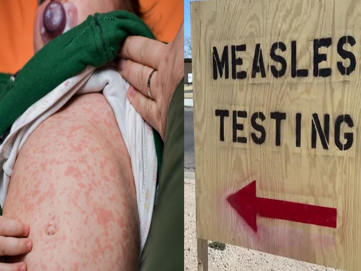 Measles के आउटब्रेक के बाद यहां हुई पहली मौत, अब तक 124 कंफर्म केस मिले