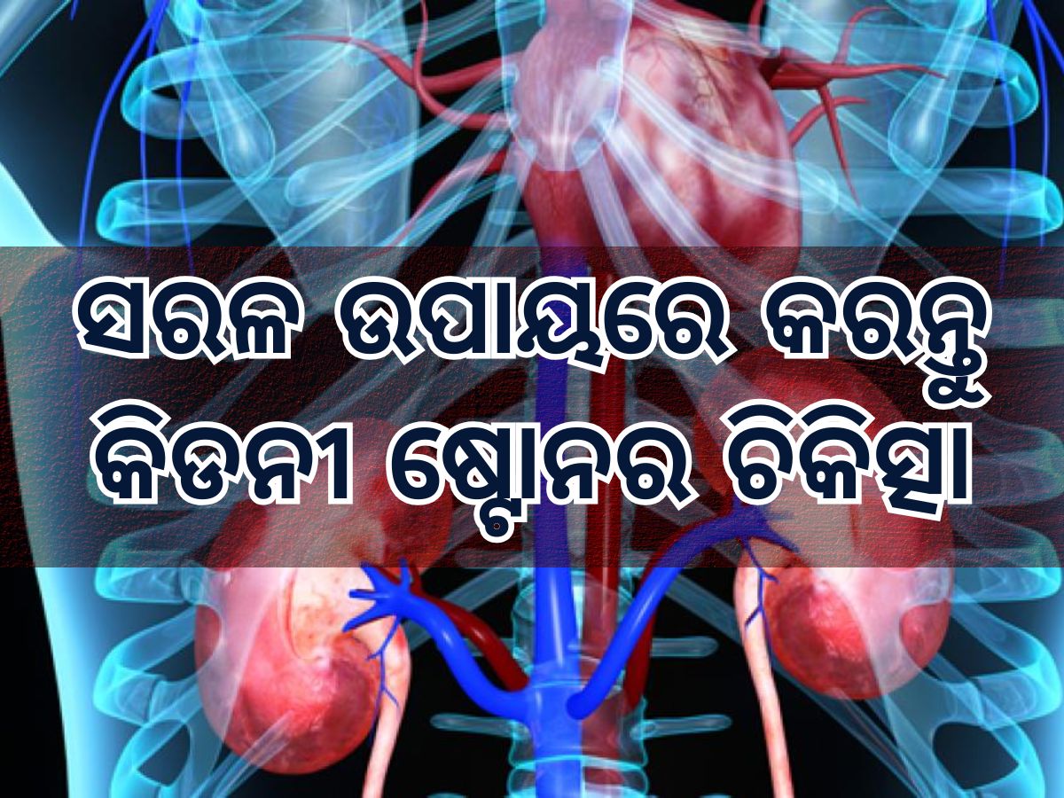 World Kidney Day: କିଡନୀରେ କାହିଁକି ହୁଏ ଷ୍ଟୋନ, କିପରି କରିବେ ଏହାର ସରଳ ଚିକିତ୍ସା World Kidney Day: କିଡନୀରେ କାହିଁକି ହୁଏ ଷ୍ଟୋନ, କିପରି କରିବେ ଏହାର ସରଳ ଚିକିତ୍ସା