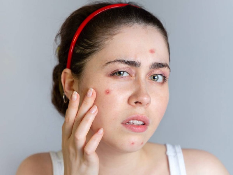 फाइन लाइन्स और पिंपल 