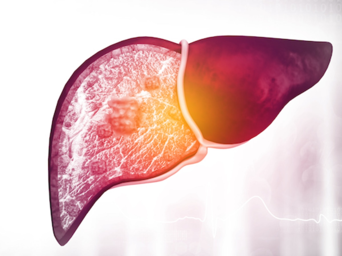 Liver Damage Causes: शरीर में इस विटामिन की कमी कारण से भी हो सकता है लिवर डैमेज