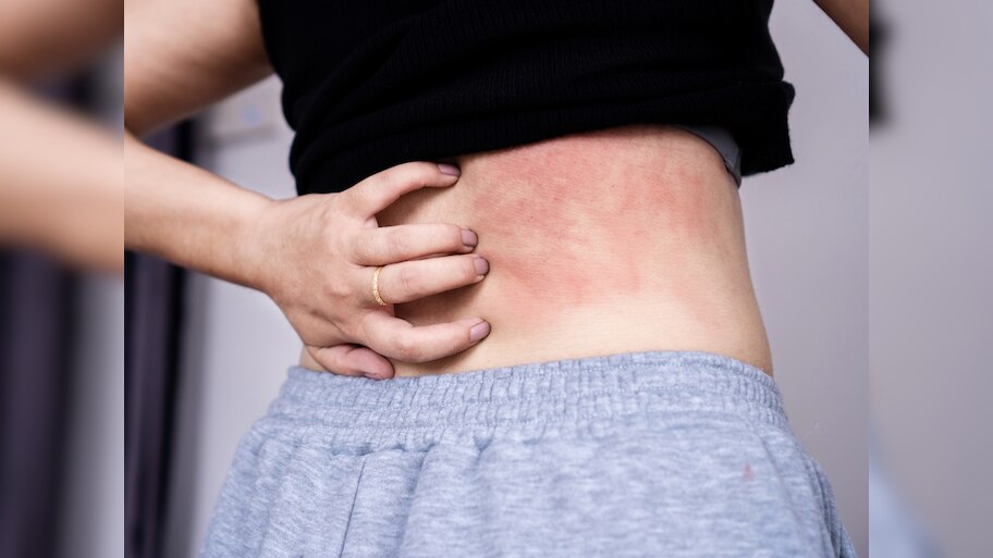 Heat rashes in summer what makes it worse and how to prevent them avoid ...