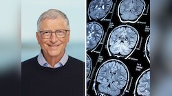 इस दिमागी बीमारी से जूझ रहे Bill Gates, बेटी ने खोला राज; जिसे जानकर हिल जाएंगे आप!