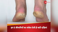 बार-बार फटती हैं एड़ियां? सिर्फ ड्राई स्किन नहीं, इन 4 बीमारियों का हो सकता है खतरा