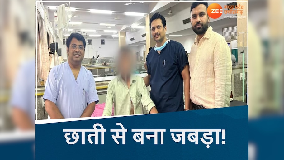 MP के BMHRC में जबड़े के कैंसर की जटिल सर्जरी, छाती से जबड़ा बनाकर बचाई जान, इस कार्ड से फ्री इलाज