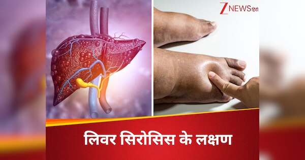 fatty liver starts becoming cirrhosis water starts filling in these ...